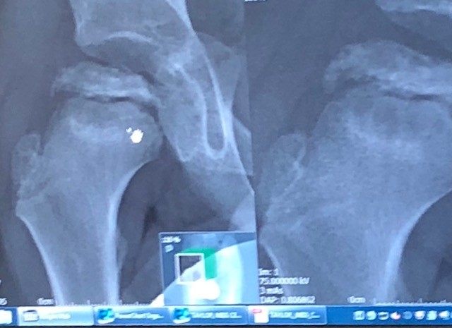 Picture comparing hip scans